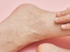 Causas y tratamiento de las varices en los tobillos