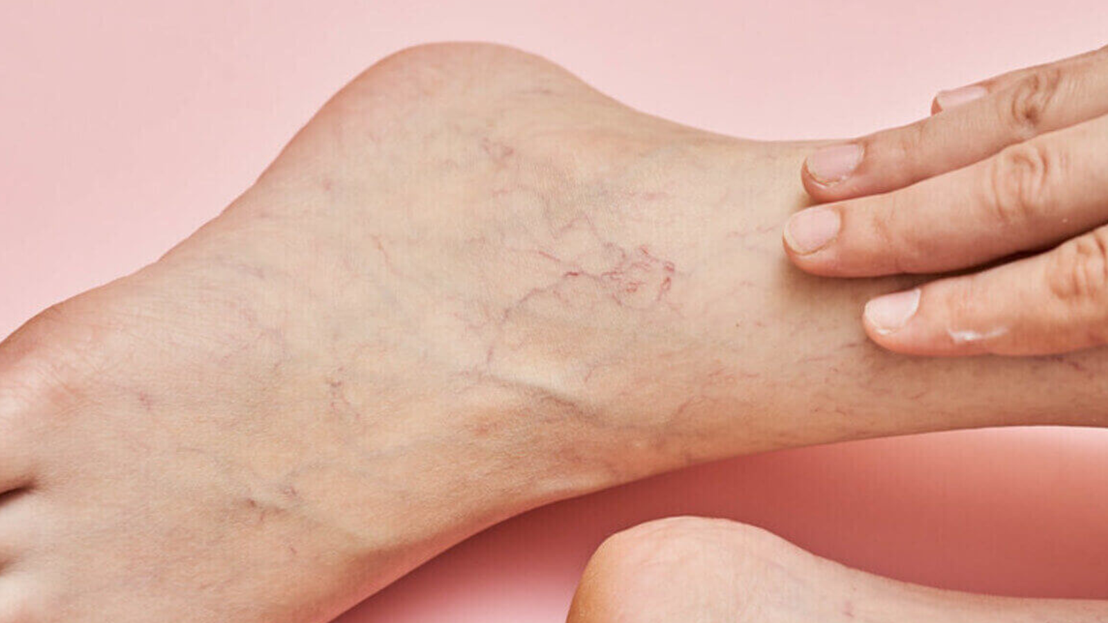Causas y tratamiento de las varices en los tobillos