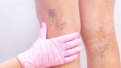 Conoce todos los tipos de varices y cómo se pueden eliminar