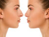 Diferencias entre rinomodelado y rinoplastia