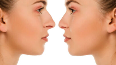 Diferencias entre rinomodelado y rinoplastia