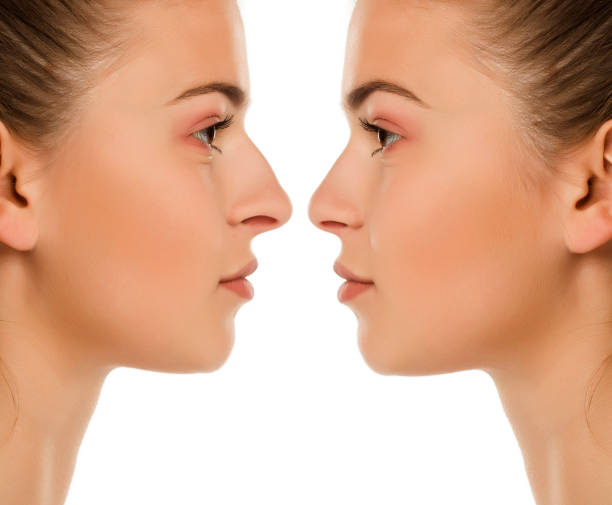 Diferencias entre rinomodelado y rinoplastia