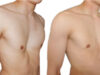 Los mejores tratamientos para corregir el pectus excavatum