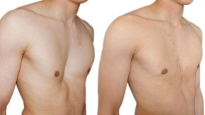 Los mejores tratamientos para corregir el pectus excavatum