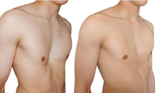 Los mejores tratamientos para corregir el pectus excavatum