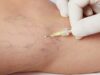 Tratamiento de varices con Microespuma: En qué consiste