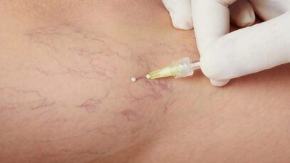 Tratamiento de varices con Microespuma: En qué consiste